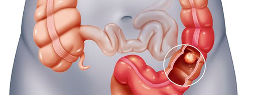 Miércoles 12/08. Webinar, cáncer colorrectal