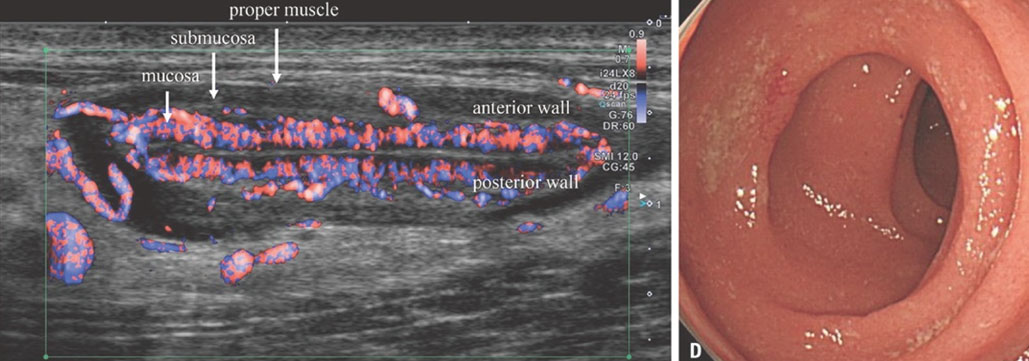 Webinar Ultrasonido Intestinal